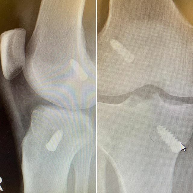 dannyjlewis's tweet photo. Yep that’s my new knee🦵#aclrecovery #aclsurgery #aclreplacement #acl https://t.co/H7jjWAGKYF https://t.co/0VxOL2S9O5