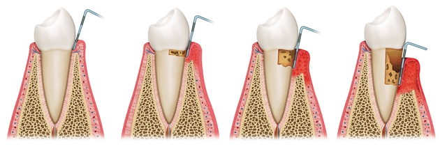 #GumDisease affects nearly 65 million people in the U.S. every year. Don’t become part of the statistic, see a periodontist today. ow.ly/T0KG50xOkls