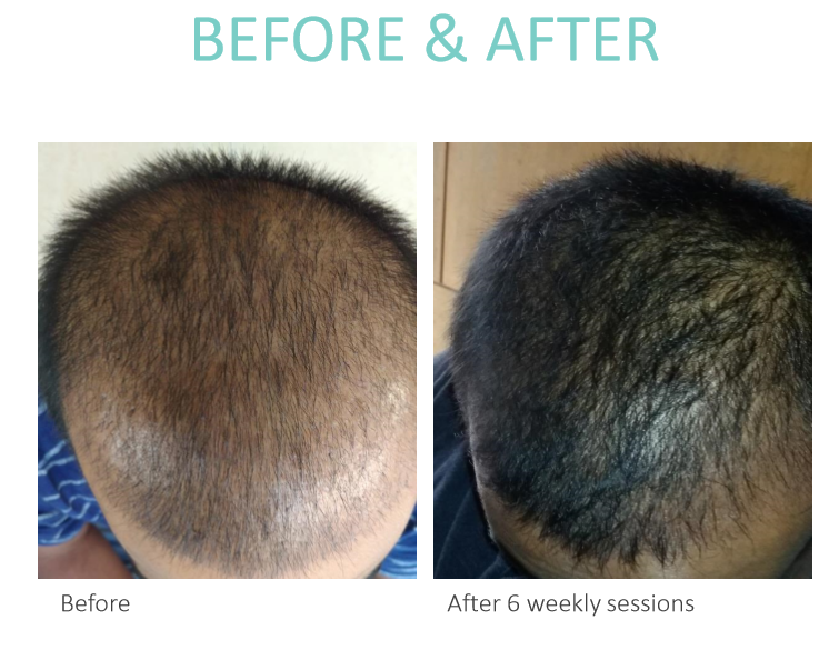 Dermaroller really helps to regrow hair on Bald Spots ? The Answer is YES . You can use Dermaroller for hair regrowth. Actually Derma roller is tool initially made for collagen production in skin to cure wrinkles, scares, stretch marks and various skin irregularities.
⁣⁣