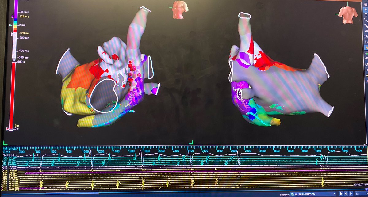 Macro-reentrant LAFL involving persistent Left SVC. Earliest Endo RFA on LAA ridge slows tachycardia. Termination from adjacent site in persistent Left SVC. Map Credit: <a href="/ellen_boucher/">Ellen Boucher</a>