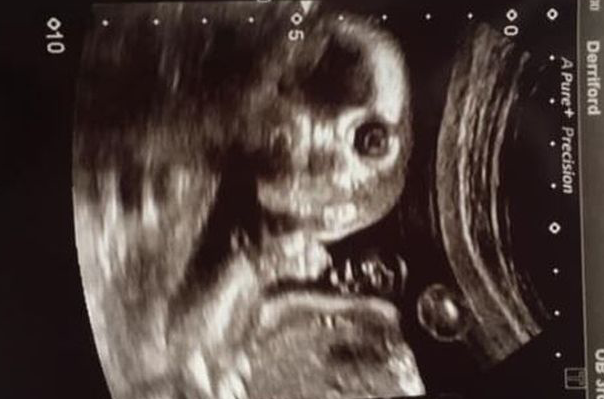 Daily Star Baby Turns And Looks At Camera In Truly Terrifying Week Scan Photo T Co S6ed9bivrl T Co Peccawasb4 Twitter