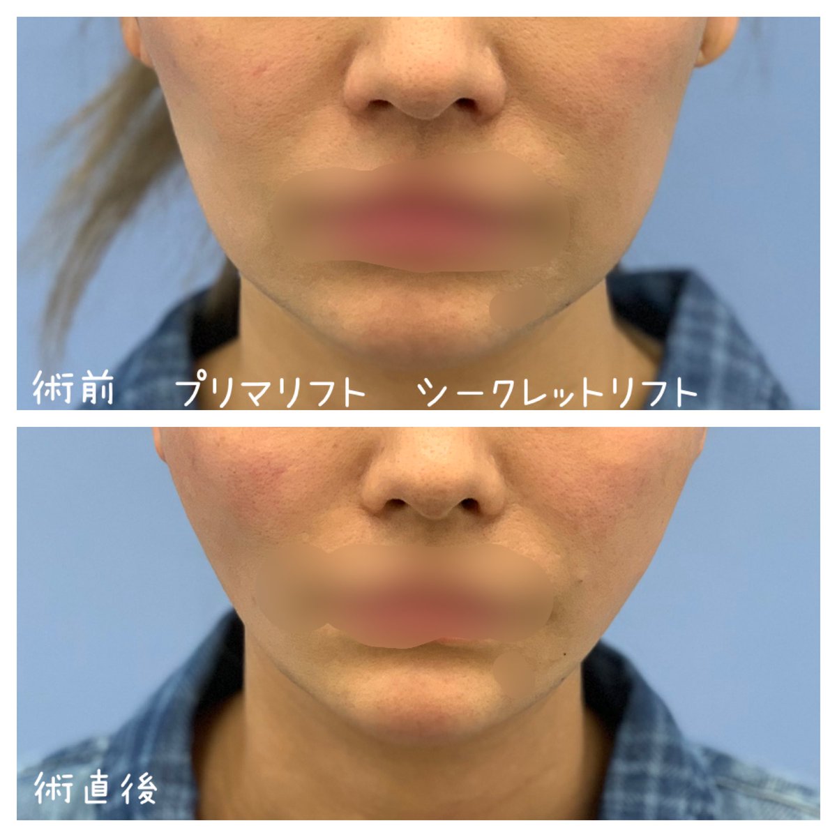 Uzivatel 湘南美容クリニック 高松院院長 多田彩子 Na Twitteru 溶ける糸による小顔 モニター様募集 新宿 札幌 辻堂院 モニター番号 無料カウンセリング 湘南美容クリニック 湘南美容クリニック新宿本院 美容外科 小顔 若返り アンチ Uzivatel 湘南美容クリニック 高松院院長 多田彩子 Na Twitteru 溶ける糸による小顔 モニター様募集 新宿 札幌 辻堂院 モニター番号 無料カウンセリング 湘南美容クリニック 湘南美容クリニック新宿本院 美容外科 小顔 若返り アンチ