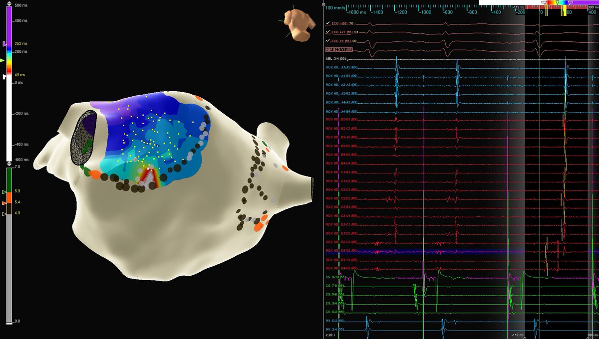 Delayed and fractionated EGMs identified with the #HDGrid in a gap of the WACA line. PVPs were so delayed that the QRS had to be used as a timing reference to extend the window further right. <a href="/andresenriqueza/">Andres Enriquez</a> <a href="/JasonBaley/">Jason Baley</a> <a href="/AbbottCardio/">Abbott Cardiovascular</a> #EPeeps #Afib