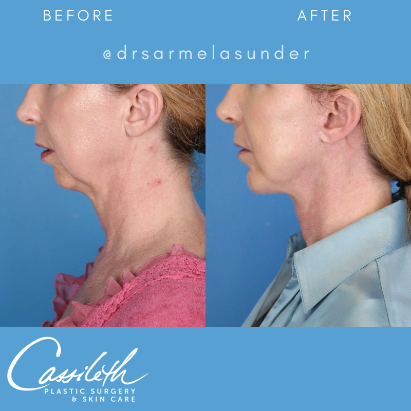 cassileth's tweet photo. 📸 #Before &amp; #After Picture Perfect Profile 
​This lovely patient underwent a lower facelift, platysmaplasty, necklift and neck liposuction with a chin augmentation by @drsarmelasunder https://t.co/khB4XgGjt9