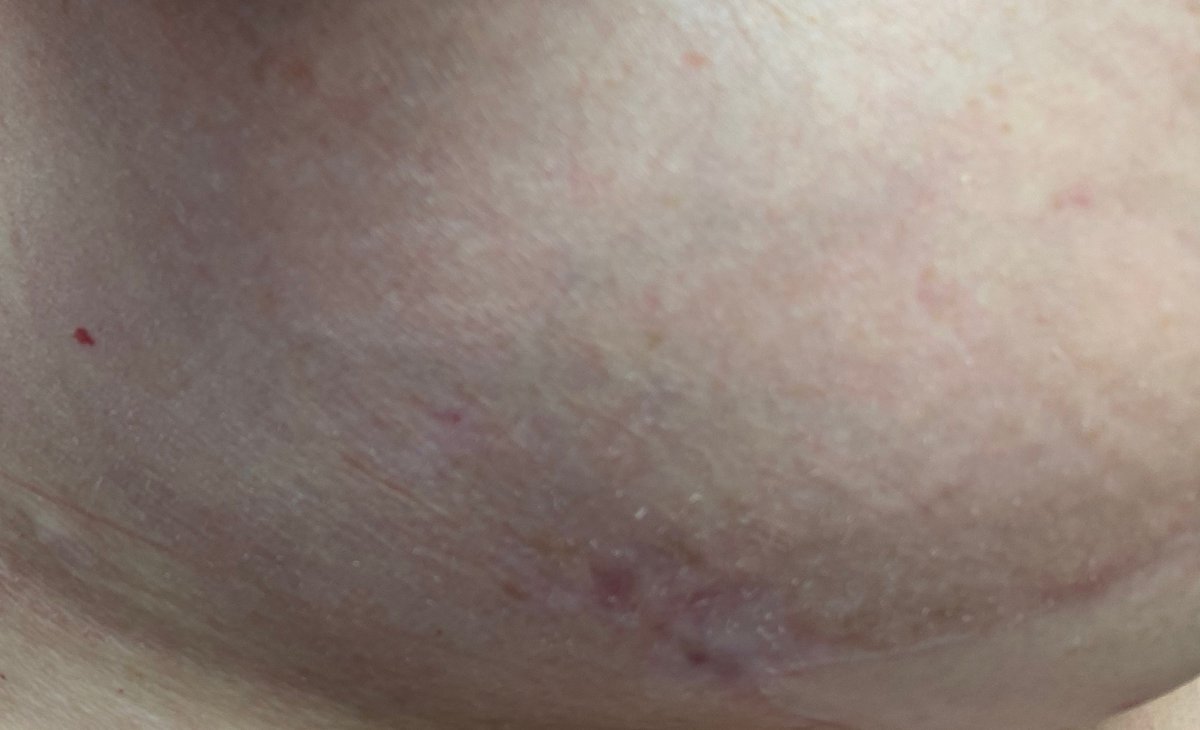 Dermaka's tweet photo. "Dermaka healed the scabs and bad pigmentation in the surrounding tissue. I have a faint scar and am really happy with Dermaka Cream. Really works!" #dermaka #dermakaheals #skincare #skinhealth #plasticsurgery #plasticsurgeon #surgery #postprocedure https://t.co/MVO0NZBd6L