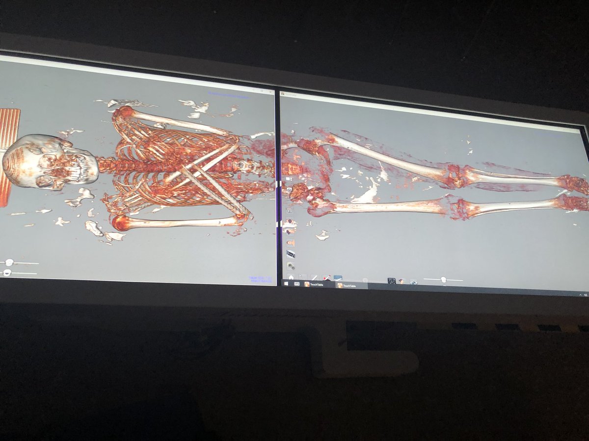 Jason Moll (@jmollbiology208) on Twitter photo Mysteries abound: split screen feature of <a href="/AnatomageTable/">Anatomage Table</a> Showing a very important piece of history unique to Berks County. <a href="/OleyValleyHS/">OVHS</a> <a href="/ovtechbuckner/">Chris Buckner</a> <a href="/amarino203/">Angela Marino</a> Mysteries abound: split screen feature of <a href="/AnatomageTable/">Anatomage Table</a> Showing a very important piece of history unique to Berks County. <a href="/OleyValleyHS/">OVHS</a> <a href="/ovtechbuckner/">Chris Buckner</a> <a href="/amarino203/">Angela Marino</a>