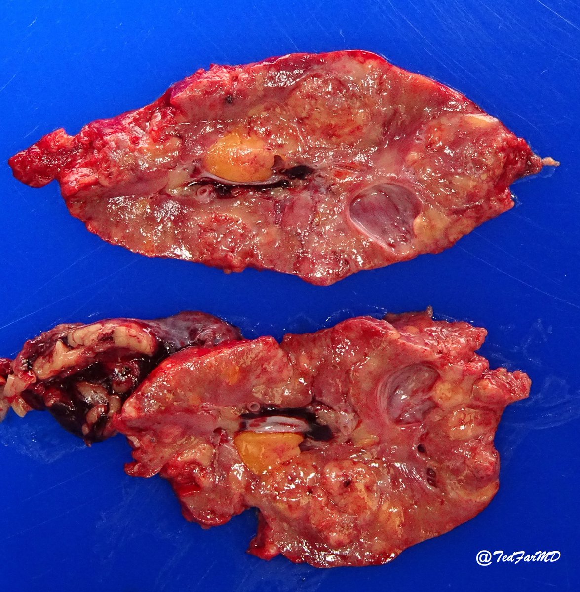 TedFarMD's tweet photo. Young 🙎‍♀️with multiple renal masses. What is your gross diagnosis? Microscopic images in thread.
#GUPath #pathboard https://t.co/Jt2xdneHnR