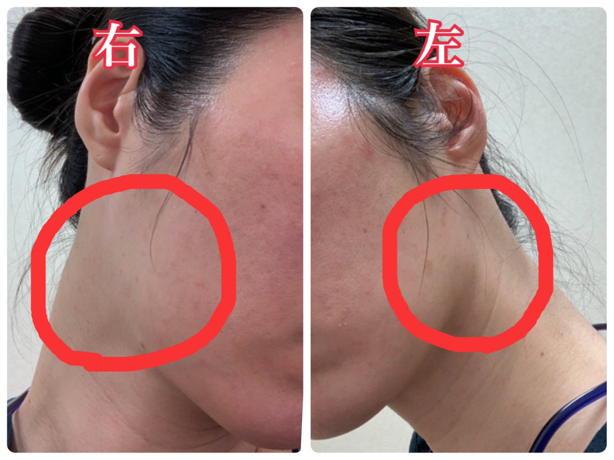 なし なし 腫れ 熱 耳 の 下 片方 痛い が