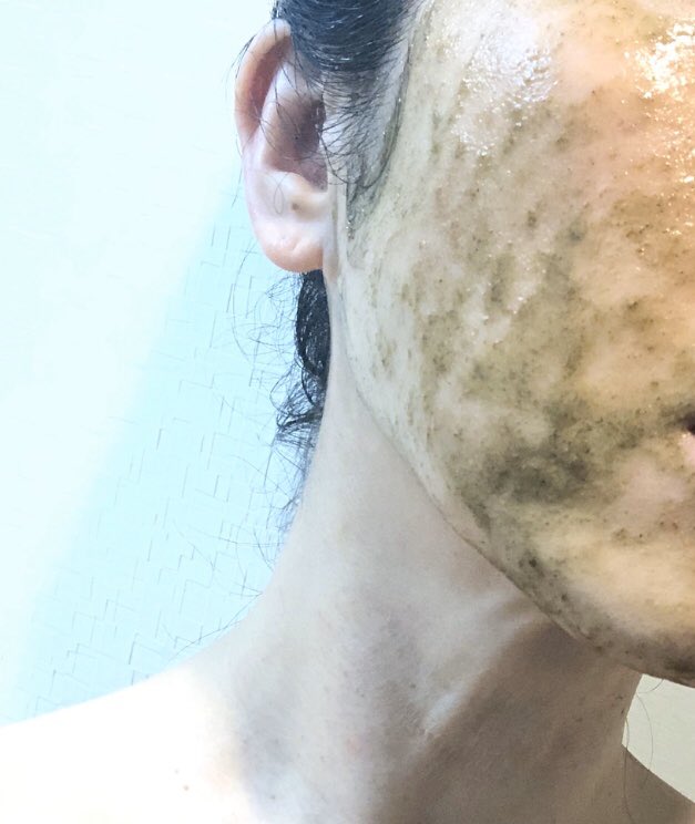 ট ইট র 広島エステ リンパマッサージ ハーブピーリング ハーブピーリング エフシープロワン ツルッとくすみもとれて 明るくなります ハーブ ピーリング ハーブエステ モニター募集 スポンジア ハーバルピール Ohlハーブピーリング 広島 ピーリング