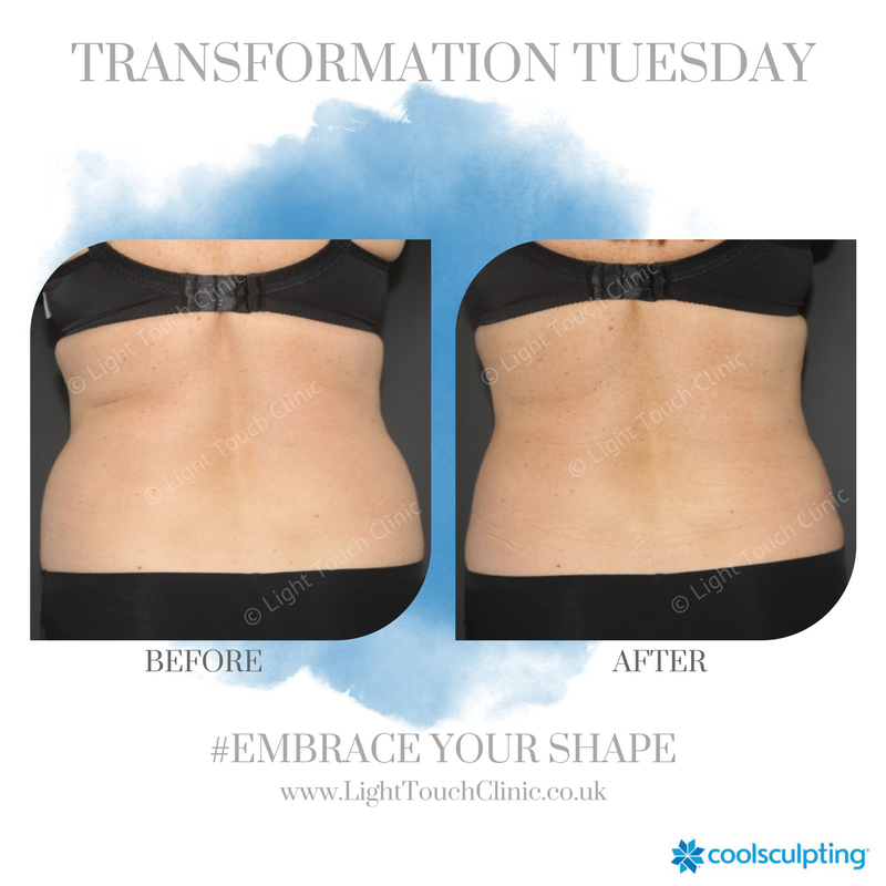 lightouchclinic's tweet photo. Eliminate stubborn fat with CoolSculpting❄️ We can specifically target those hard to get rid of areas with our specialist applicators.

To book a consultation and see what CoolSculpting can do for you, get in touch!

📞- 01932 849552
✉️- info@lighttouchclinic.co.uk https://t.co/g4r2Kaxf3k