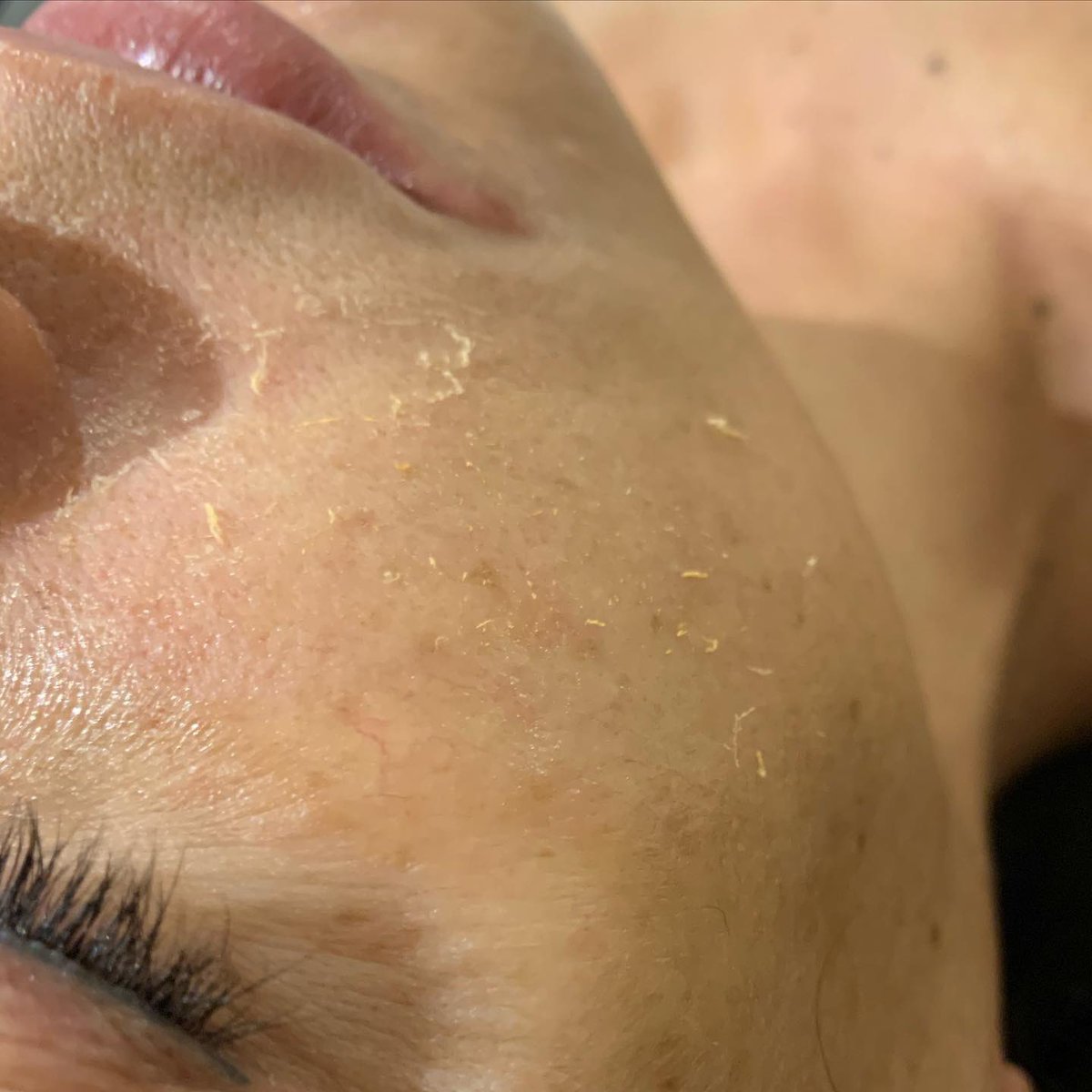 jocolettaskin's tweet photo. D M K.  Q U I C K.  P E E L.

Quick Peel works to rapidly reduce inflammation, kill infection, +improve the functionality of the skin with poor healing capacity. It improves oxygenation to tissues + strengthens capillaries and removes dead skin cells.

#dmkuk #dmkskin #dmkrrpm https://t.co/WXFOrDGY1F