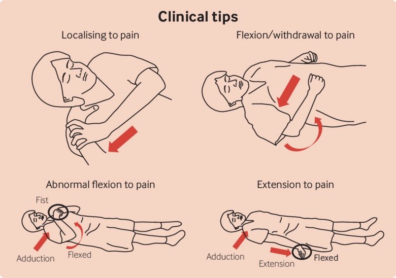 Glasgow coma scale The glasgow-coma-scale-the