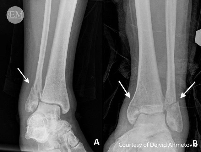 iem_student's tweet photo. "Lower Extremity Injuries" by Ayse Ece Akceylan
#FOAMed #emergencymedicine #ICON360 #iEMstudent #ED #MedEd #medicalstudent #clerkship #EmergencyDepartment #Fracture #Disclocation #orthopedics #Pain #Hip #Knee #Ankle

Read full text: https://t.co/eeSUSdMvWU https://t.co/4gFDFfVIE4