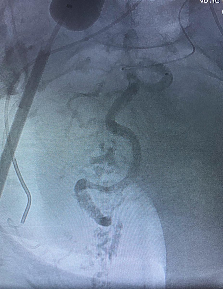 irdocnigeria's tweet photo. When you have @AVanceIR and @DoctorUche at the Irdocnigeria practice in lagos, we get into some complex stuff. Complex pelvic avm fed by corona mortis(EIA) and IMA treated with glue embolization. Yes in lagos!!! #wearesimplyonamission @SIRspecialists @IN_publishing #healthcare https://t.co/xA2KWHWTxN