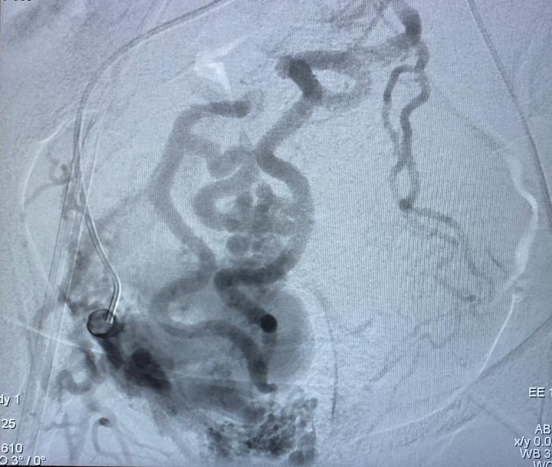 irdocnigeria's tweet photo. When you have @AVanceIR and @DoctorUche at the Irdocnigeria practice in lagos, we get into some complex stuff. Complex pelvic avm fed by corona mortis(EIA) and IMA treated with glue embolization. Yes in lagos!!! #wearesimplyonamission @SIRspecialists @IN_publishing #healthcare https://t.co/xA2KWHWTxN