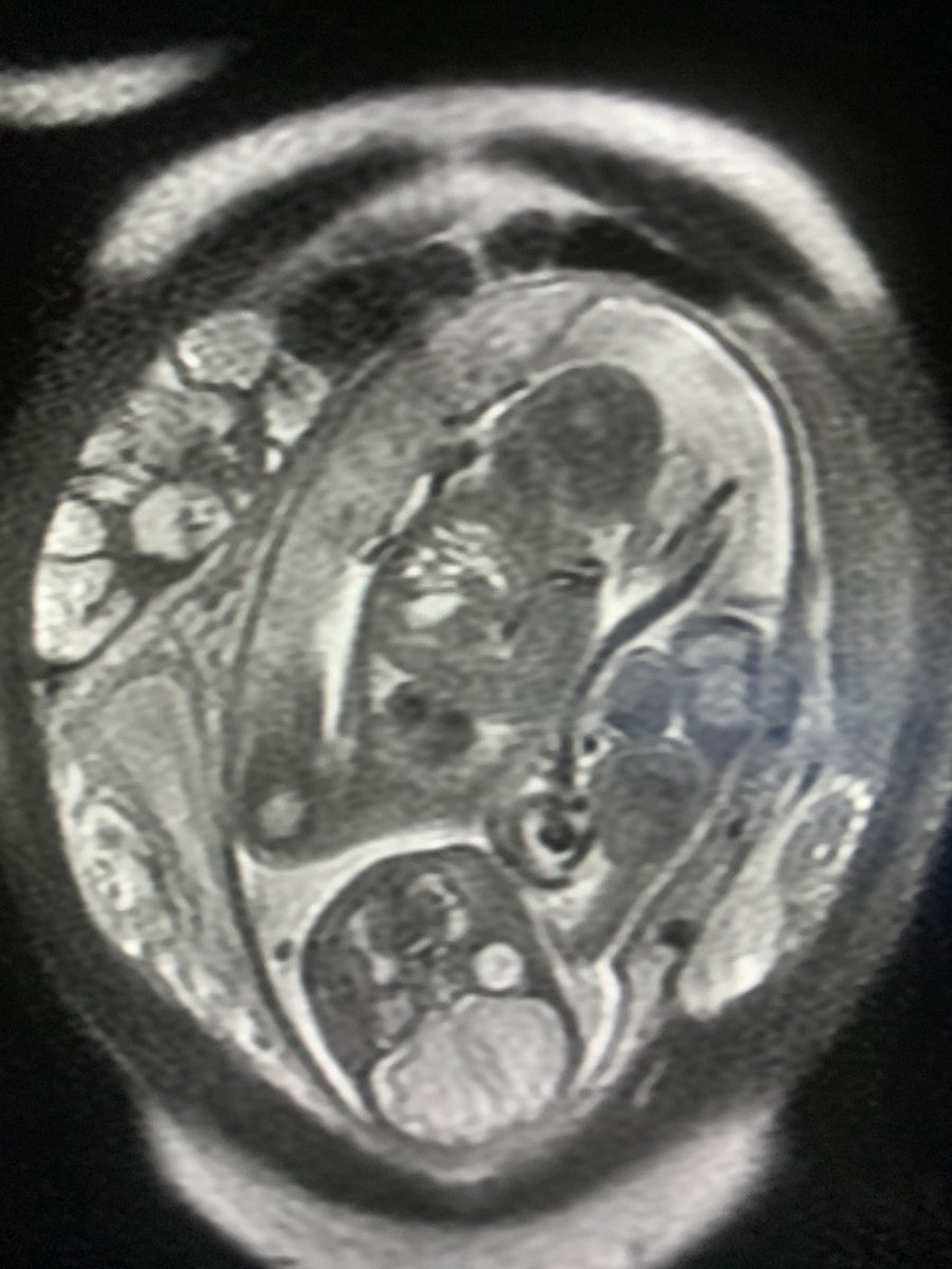 danortizmd's tweet photo. Bicornuate uterus with pregnancy. #radres #bodyrad #genrad https://t.co/T7GBPV0nTS
