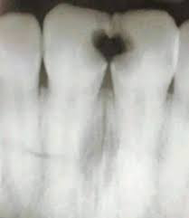 The same romance that fills your heart can also leave holes in your teeth! 😱 Don’t let your #ValentinesDay candy deteriorate your achy breaky enamel 🦷💙