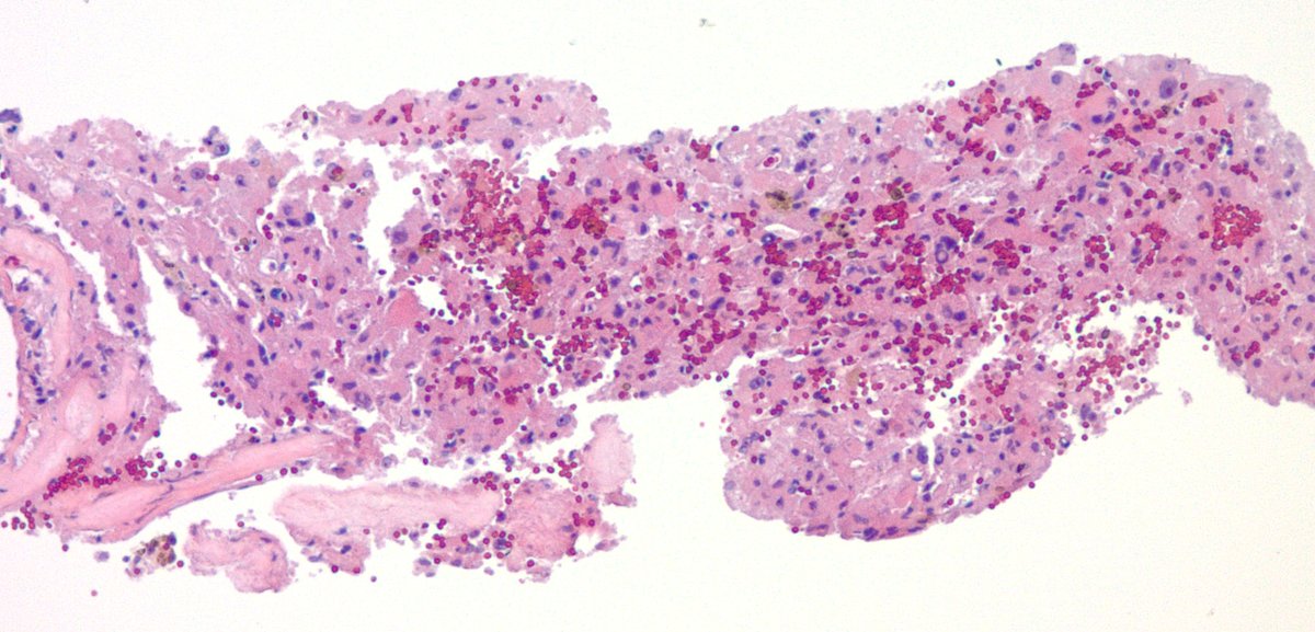 jake_bledsoe's tweet image. Biopsy of an incidentally discovered 5 cm well-circumscribed retroperitoneal mass abutting the bladder in a middle aged adult. Does anyone want to hazard a guess before I show the IHC? #BSTpath #pathology