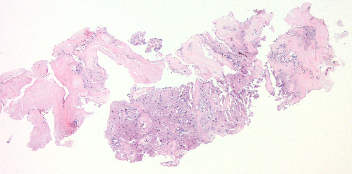 jake_bledsoe's tweet image. Biopsy of an incidentally discovered 5 cm well-circumscribed retroperitoneal mass abutting the bladder in a middle aged adult. Does anyone want to hazard a guess before I show the IHC? #BSTpath #pathology