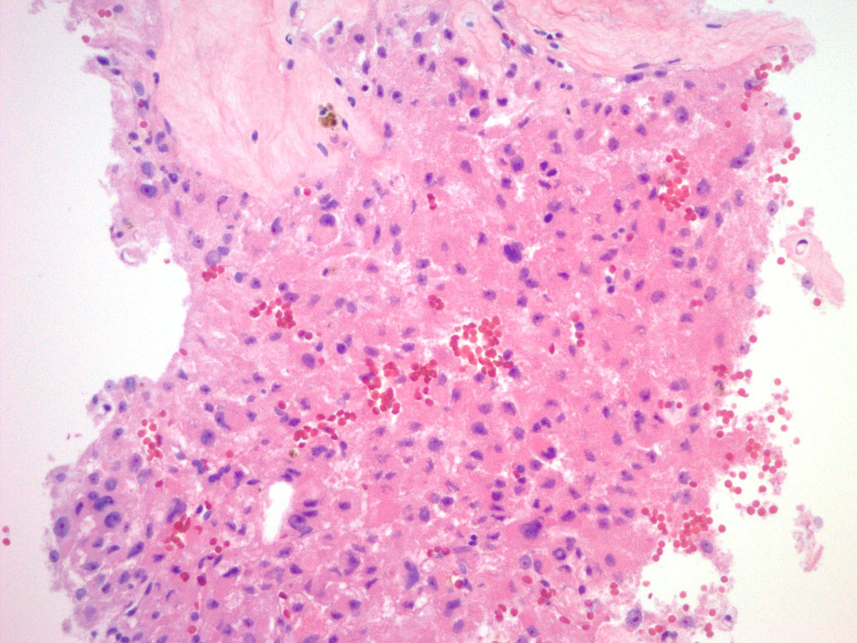 jake_bledsoe's tweet image. Biopsy of an incidentally discovered 5 cm well-circumscribed retroperitoneal mass abutting the bladder in a middle aged adult. Does anyone want to hazard a guess before I show the IHC? #BSTpath #pathology