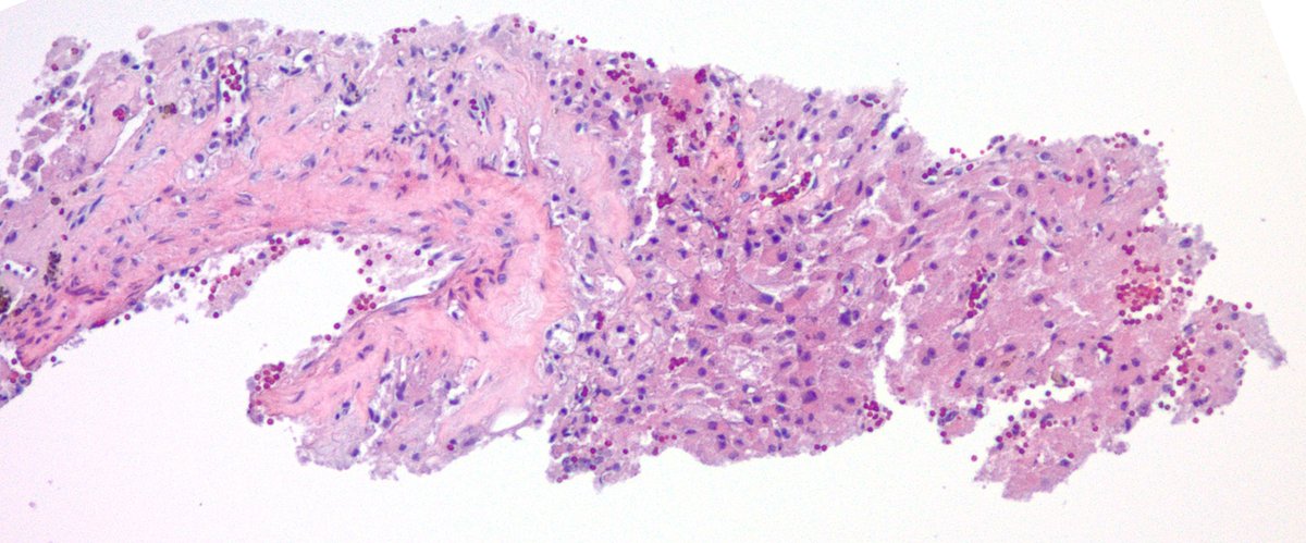 jake_bledsoe's tweet image. Biopsy of an incidentally discovered 5 cm well-circumscribed retroperitoneal mass abutting the bladder in a middle aged adult. Does anyone want to hazard a guess before I show the IHC? #BSTpath #pathology