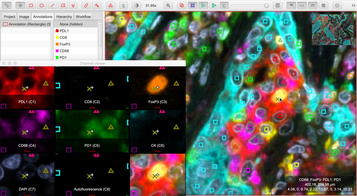 petebankhead's tweet image. @QuPath v0.2.0-m9 is now available at qupath.github.io - lots of new things in this release, including entirely rewritten object classifiers, new commands, and many improvements for fluorescence &amp;amp; multiplexed analysis 

#opensource #bioimageanalysis #digitalpathology