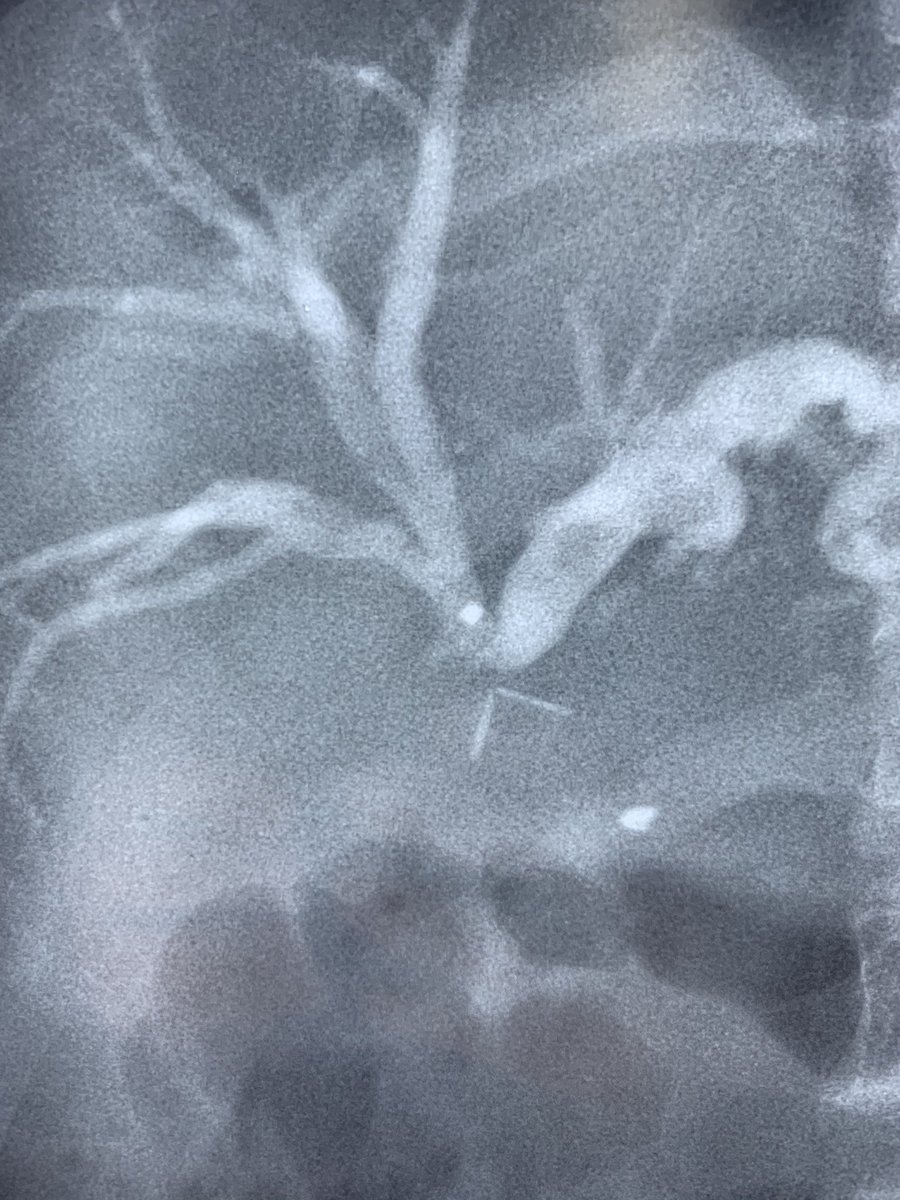 CMZavaletaMD's tweet photo. #PTHC abordaje derecho encontrando estenosis crítica sin paso de material de contraste al asa de yeyuno. Se intentó con guías rectas y anguladas sin éxito. Se catéter dirigido a colangiolo izquierdo para drenaje externo. https://t.co/Hf0rOMlE89