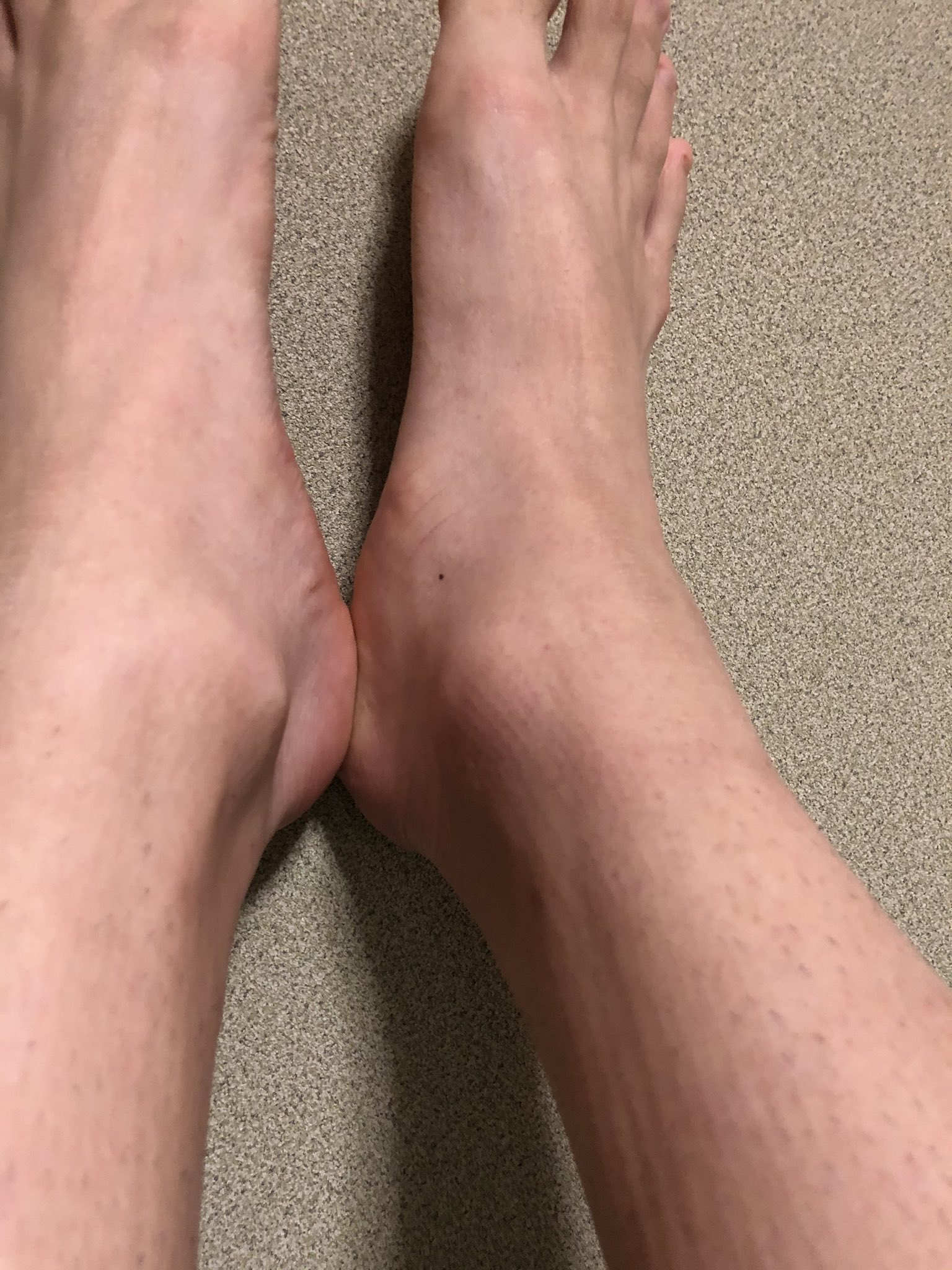 توییتر はんだ しりゅう در توییتر 3日前くらいからくるぶしの下辺りが痛くて痛みは変わらず日に日に腫れは増していく なんか疲労 骨折とかかな T Co Lftfhmhgfl