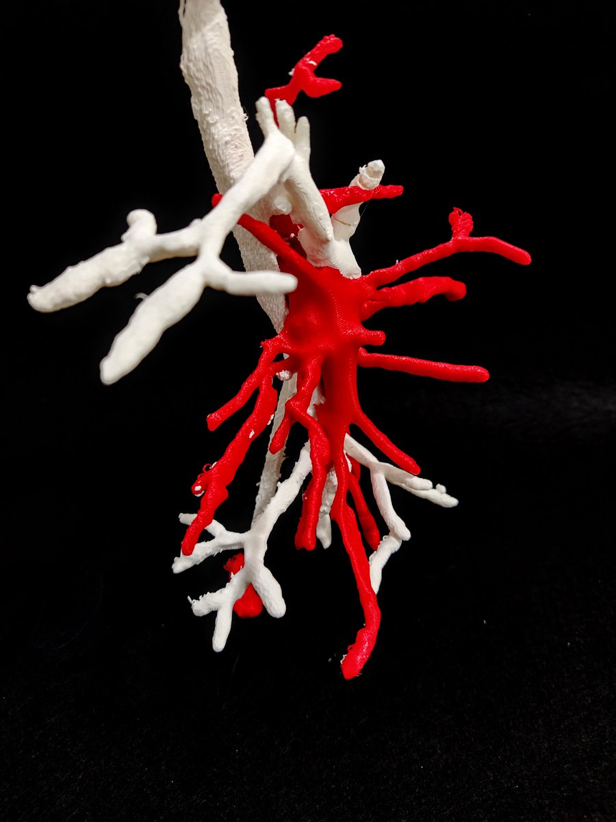 saludtecnolab's tweet photo. #Thoracicsurgery #ThoracicSurgeons #LungCancer
#sublobarresection @3DSlicerApp #3Dmodel
#3Dprinted https://t.co/peDgp7Mgxf