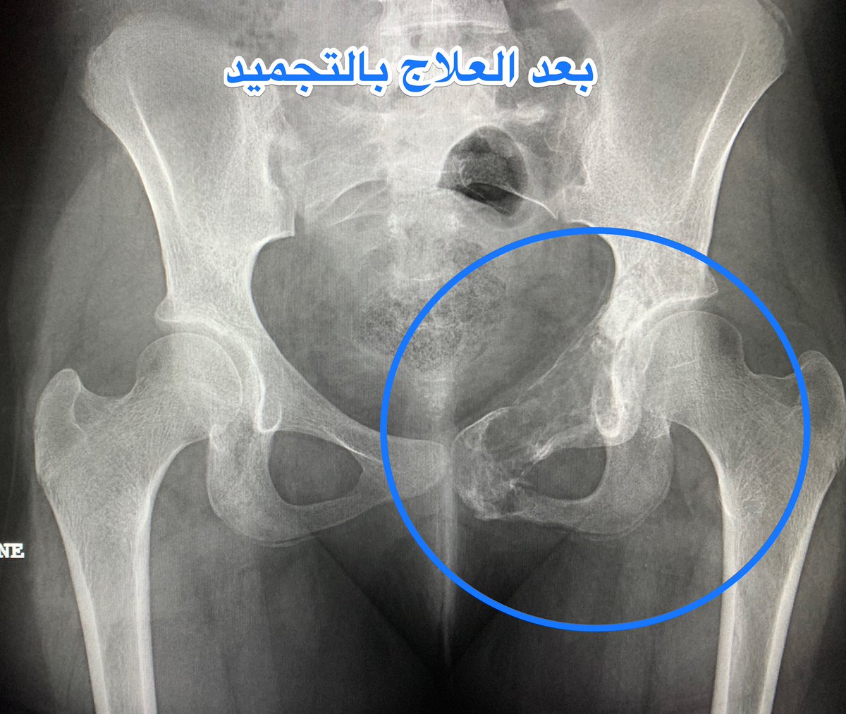 أسعد اللحظات هي عندما تنجح في تخفيف معاناة مريضك وتكون سبباً في ذلك!
علاج ورم في عظم الحوض واعادة بنائه بتقنية #الكريوثيرابي مع الحفاظ على مفصل الحوض
تحت اشراف قسم الأشعة التداخلية وقسم أورام العظام ب #مدينة_الملك_فهد_الطبية
<a href="/KFMC_RIYADH/">مدينة الملك فهد الطبية</a> 
 <a href="/Cluster2_Riyadh/">تجمع الرياض الصحي الثاني</a>