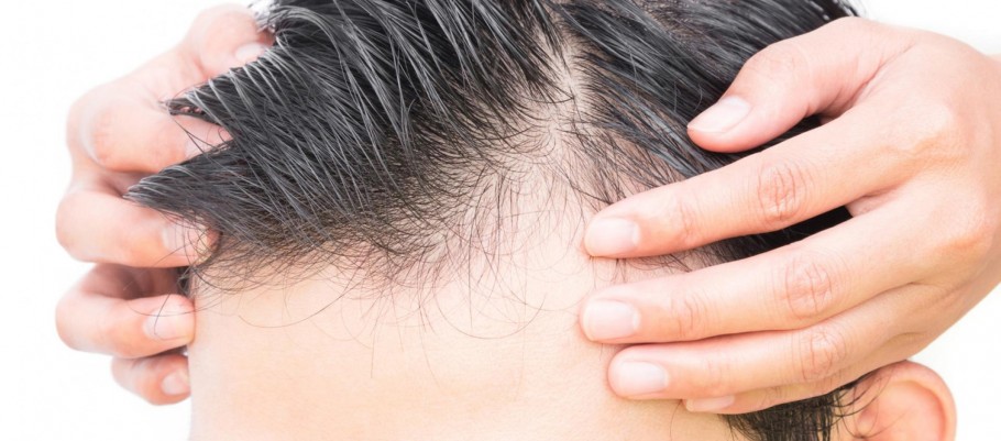 From a certain age, more than half of men experience hair loss for various reasons. Most of them are permanent and are called "androgenic hair loss"
designated.

For detailed information;

innovationhairtransplant.com