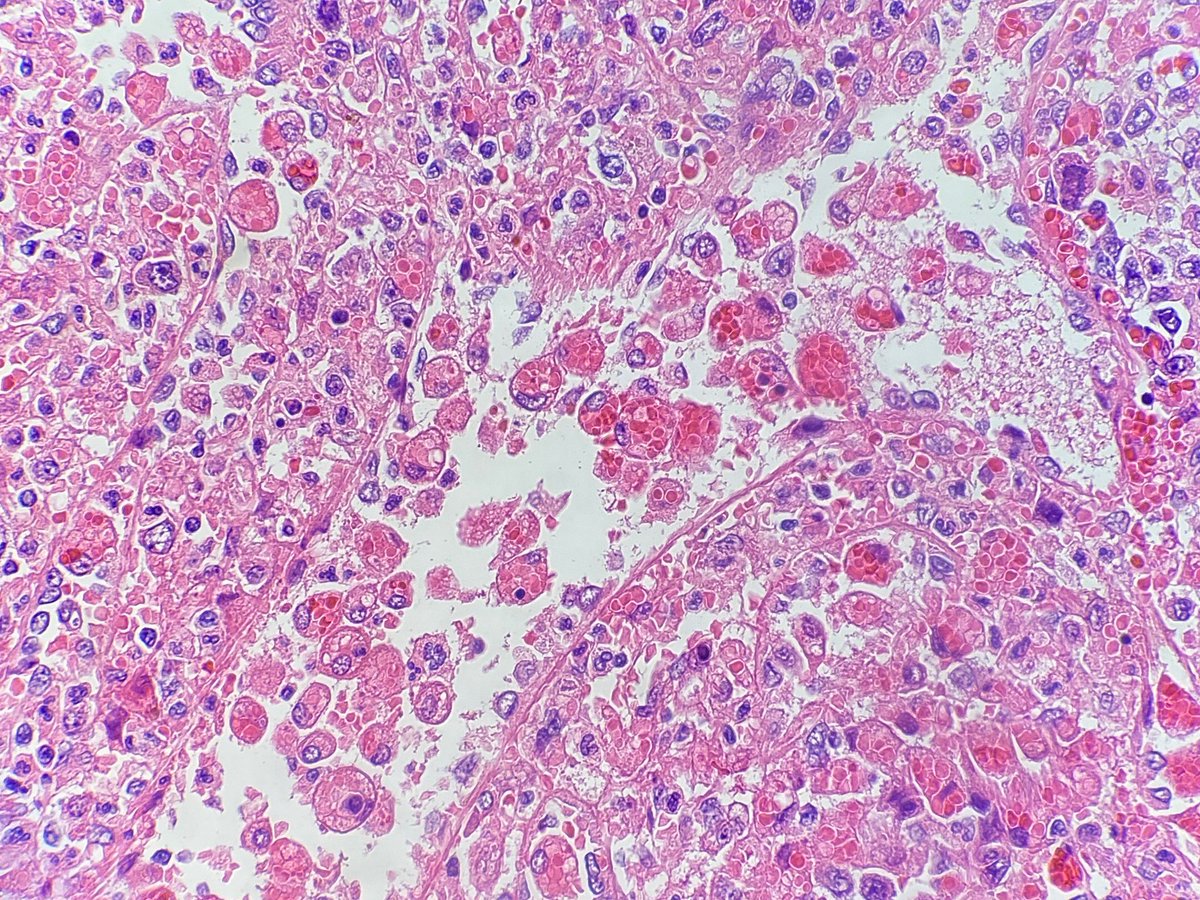 JingZhangMDPhD's tweet image. This was one of the most remarkable examples of hemophagocytosis I’ve ever seen. The section is from a splenectomy specimen from a patient with EBV+ DLBCL. #HLH