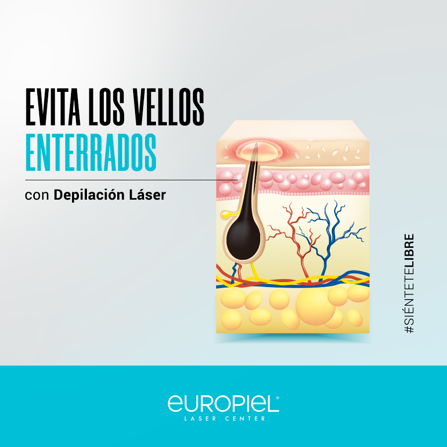 EuropielC's tweet photo. Con el rastrillo se te entierran los vellitos que provocan la aparición de pequeños bultos en la piel.
👉La solución: #EuropielLáserCenter 

📍Visítanos en nuestra página web para más información sobre nuestros paquetes de depilación https://t.co/N6l41zbYXA