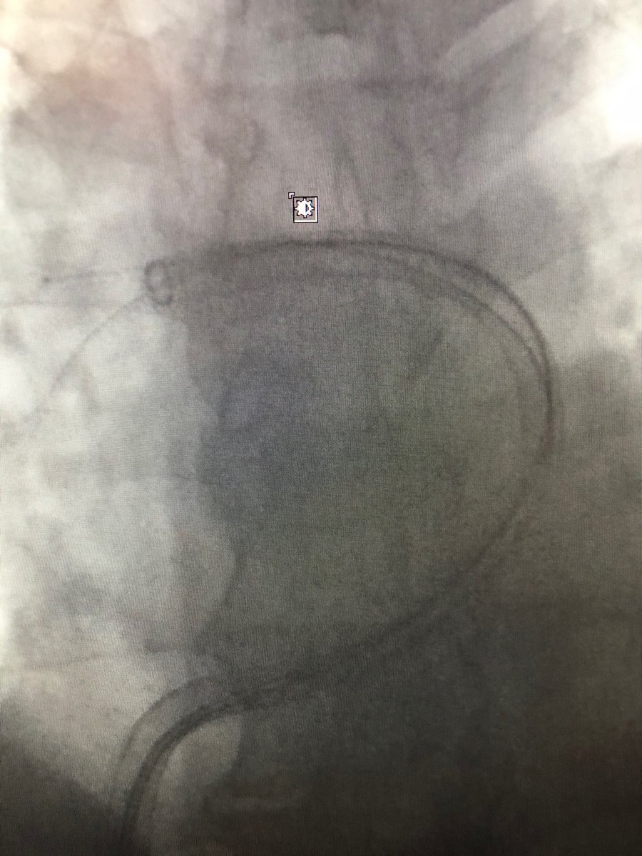 roblookstein's tweet photo. Live @MountSinaiIR Another #PERT activation for high risk submassive PE treated by @titan0_IR_md and @RSP516 with #flowtriever PA pressures went down from 42 to 28mmHg on the table @PERTConsortium @InariMedical https://t.co/z1F5RAnx9d
