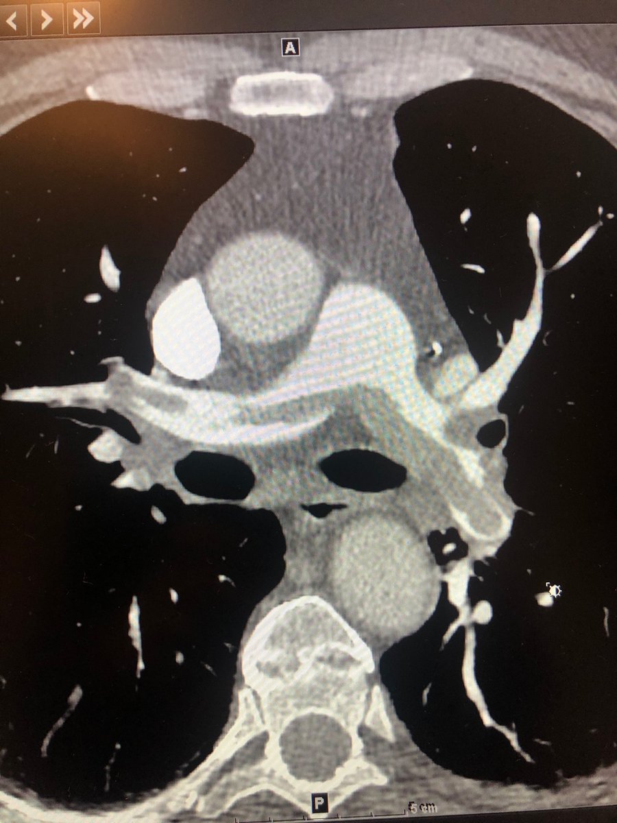 roblookstein's tweet photo. Live @MountSinaiIR Another #PERT activation for high risk submassive PE treated by @titan0_IR_md and @RSP516 with #flowtriever PA pressures went down from 42 to 28mmHg on the table @PERTConsortium @InariMedical https://t.co/z1F5RAnx9d