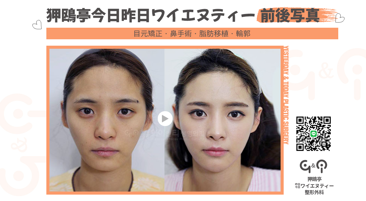 高い鼻 高い鼻