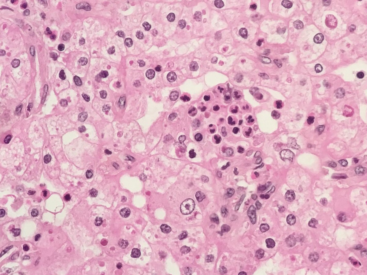 MayaNourieh's tweet image. Renal tumor. Guess the stain and diagnosis. I will add some other H&amp;amp;E pictures @MondorPath #GUpath