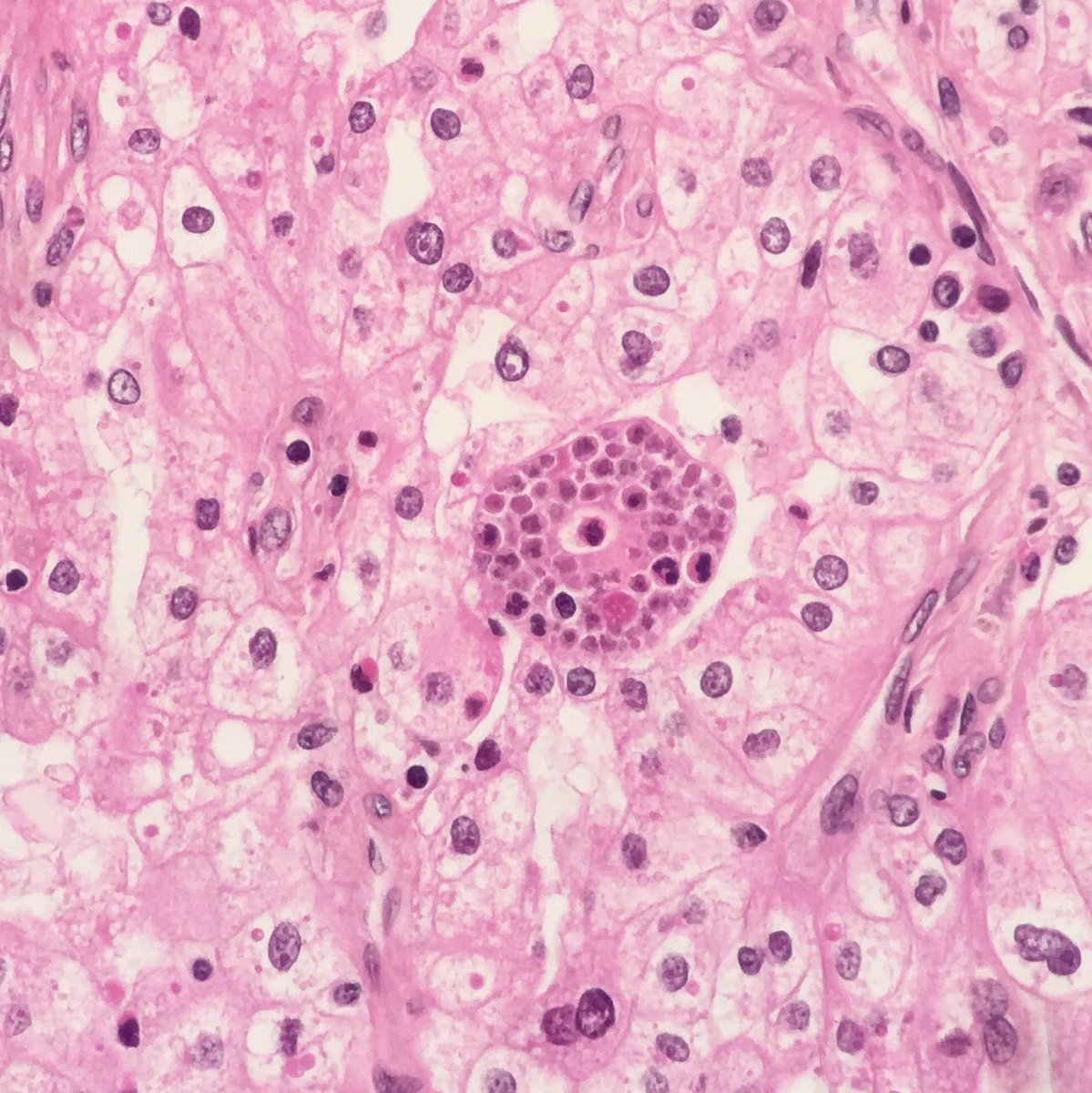 MayaNourieh's tweet image. Renal tumor. Guess the stain and diagnosis. I will add some other H&amp;amp;E pictures @MondorPath #GUpath
