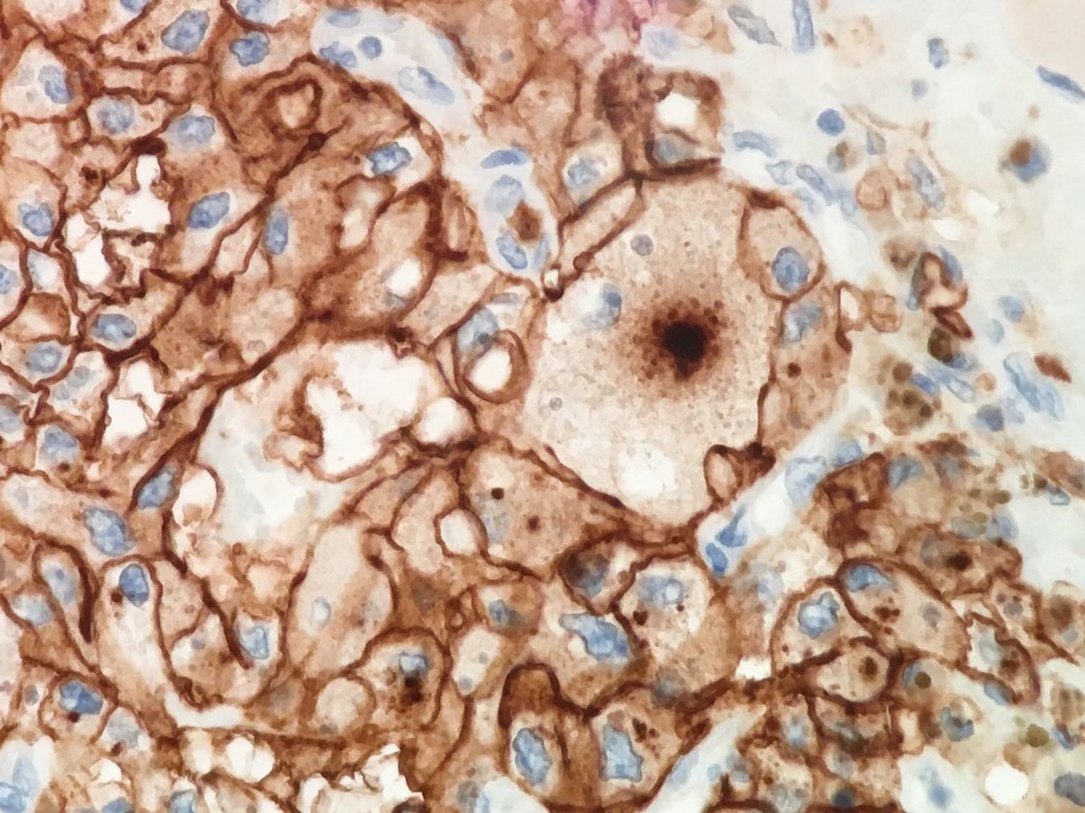 MayaNourieh's tweet image. Renal tumor. Guess the stain and diagnosis. I will add some other H&amp;amp;E pictures @MondorPath #GUpath
