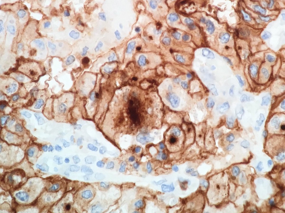MayaNourieh's tweet image. Renal tumor. Guess the stain and diagnosis. I will add some other H&amp;amp;E pictures @MondorPath #GUpath