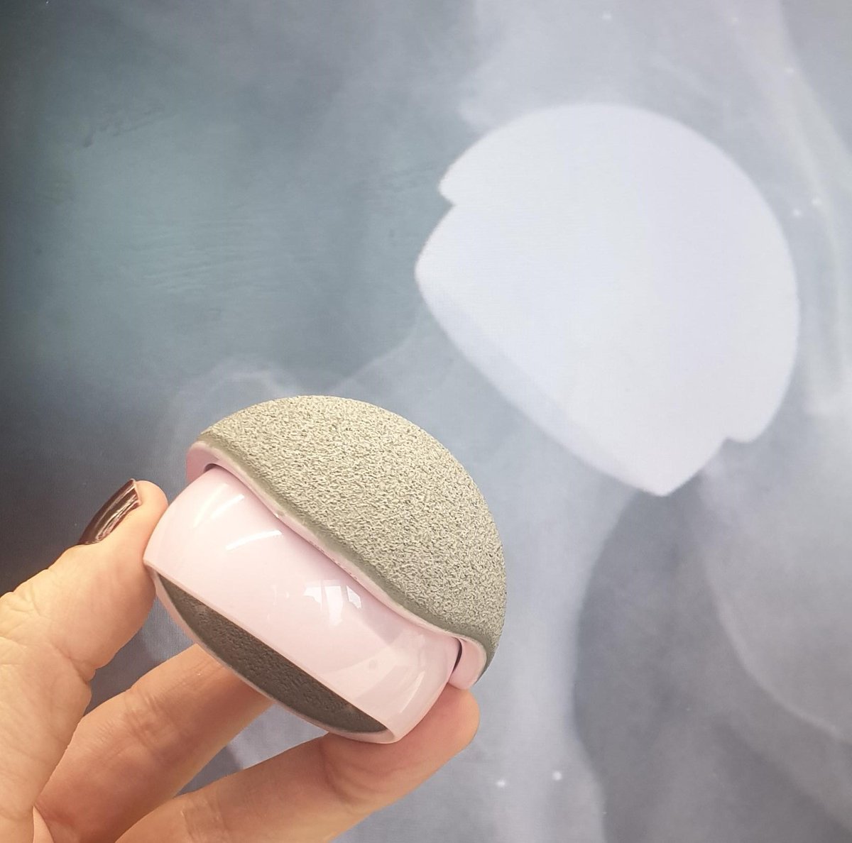 Justin Cobb (@orthorobodoc) on Twitter photo H1 ceramic hip resurfacing reached 100 this week! Cases 95-100 all went well with help from Sarah Muirhead Alwood and the team <a href="/ImperialNHS/">Imperial NHS 💙</a>, <a href="/KEVIIHospital/">King Edward VII's Hospital</a>, <a href="/embodyortho/">Embody</a>, <a href="/ceramtec/">Amireshonam Ceram teck</a> <a href="/MSkLab1/">MSk Lab</a> <a href="/ImperialSandC/">Surgery and Cancer</a> H1 ceramic hip resurfacing reached 100 this week! Cases 95-100 all went well with help from Sarah Muirhead Alwood and the team <a href="/ImperialNHS/">Imperial NHS 💙</a>, <a href="/KEVIIHospital/">King Edward VII's Hospital</a>, <a href="/embodyortho/">Embody</a>, <a href="/ceramtec/">Amireshonam Ceram teck</a> <a href="/MSkLab1/">MSk Lab</a> <a href="/ImperialSandC/">Surgery and Cancer</a>