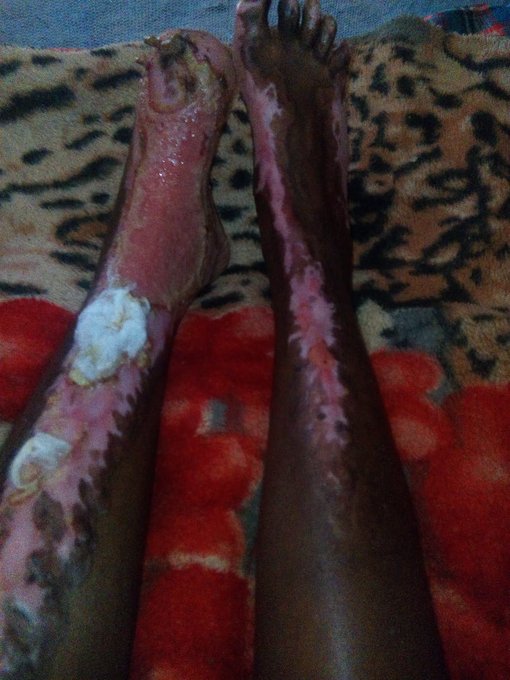 Citizens of good will I'm appealing for help on my girlfriend behalf who got injured. Please @HassanAliJoho<a href="/tag/uhurumustgo"class="tags"><span>#uhurumustgo</span></a>