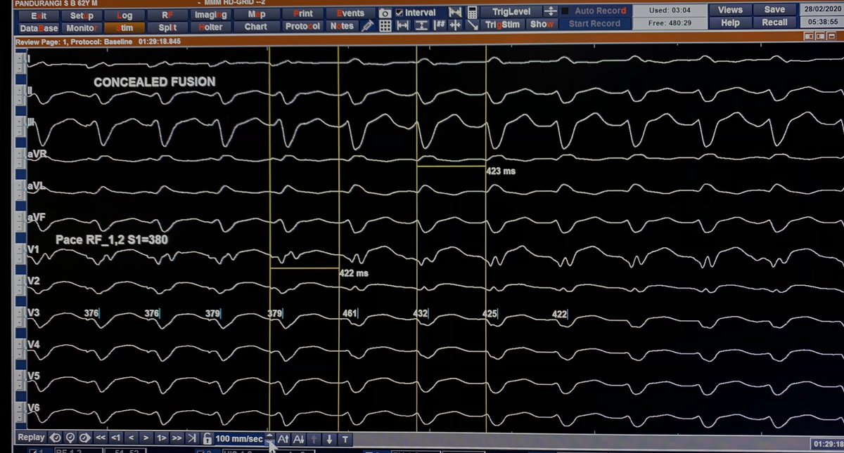 UlhasDr's tweet photo. His Dissociated BBRT! @SchakrabartiEP @narrowQRS @rdschaller @ecgrhythms @drnjy @SuchitMajumder @DCR_Dr @Vadeboncoeur_Al @smithECGBlog @Hapa_EP @PaymardM @chaturvedimd @Epeeps_Bot #AblateVT #ablation #Epeeps https://t.co/OBff7FqBtn