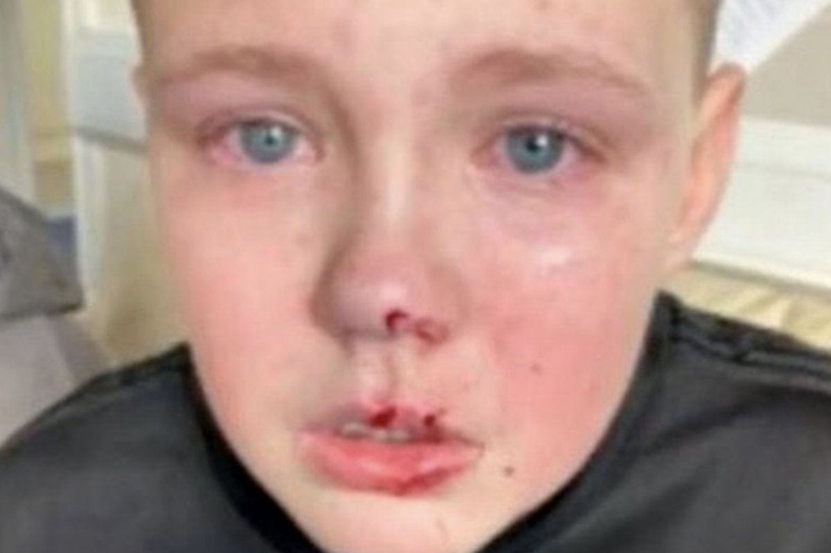 Schoolboy, 12, left covered in blood after being beaten in attempted robbery mirror.co.uk/news/uk-news/s…