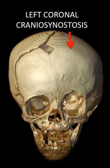RyanVargas_23's tweet photo. “Why do you do that thing with your eyebrow?”🤔

Well, growing up with Craniosynostosis, specifically Coronal-synostosis, it caused my left eye socket to be slightly higher than the other.

It’s something I used to be self-conscious about, but now I wear it proud.💜
#FactFriday https://t.co/7TllrCkmE0