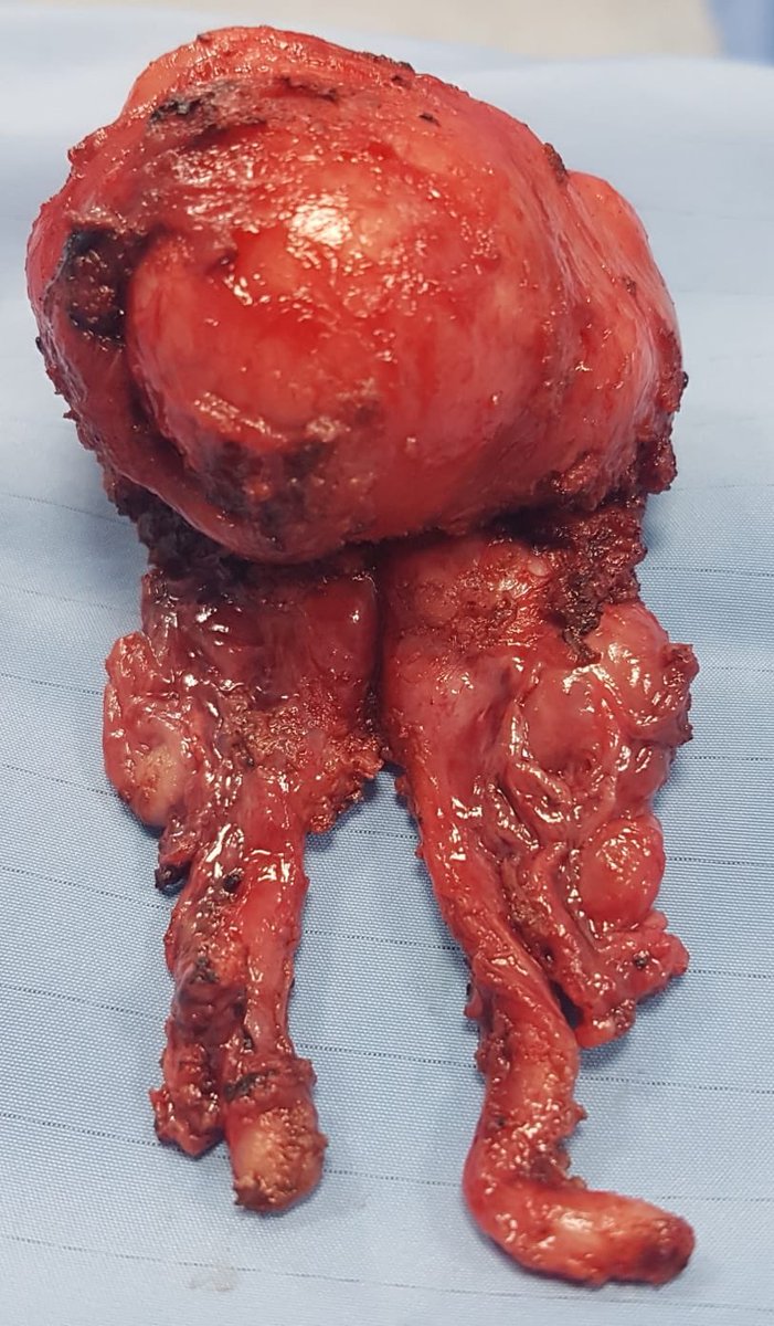 vincenzo ficarra (@ficarravincenzo) on Twitter photo My first #retziussparing with big medium lobe. It can be done! <a href="/agalfano/">Antonio Galfano</a> <a href="/aldomassimo10/">Aldo Bocciardi</a> <a href="/Uroweb/">European Association of Urology (EAU)</a> <a href="/AmerUrological/">Amer. Urol. Assn.</a> My first #retziussparing with big medium lobe. It can be done! <a href="/agalfano/">Antonio Galfano</a> <a href="/aldomassimo10/">Aldo Bocciardi</a> <a href="/Uroweb/">European Association of Urology (EAU)</a> <a href="/AmerUrological/">Amer. Urol. Assn.</a>