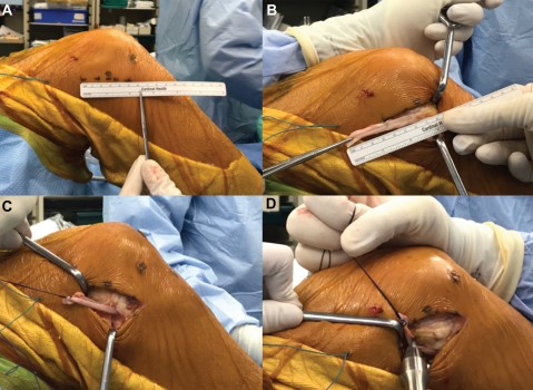 aossmjournals's tweet image. O’Donoghue Award–winning paper by @FKSMC_Getgood and STABILITY Study Group shows reduced #ACLR failure rate with addition of lateral extra-articular tenodesis (LET) in young, high-risk patients
ow.ly/DNAl50yoyKV