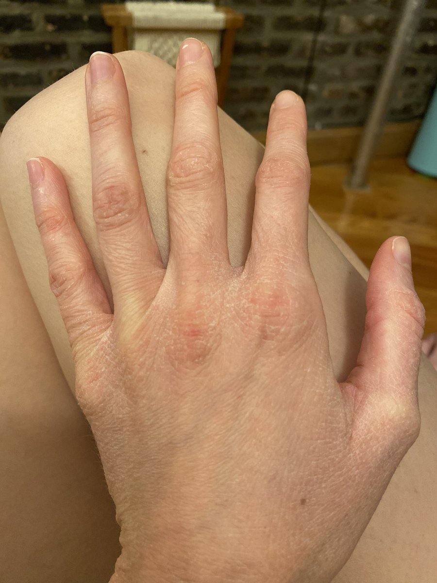 Sara Rathner I Get Very Dry Hands In The Winter And Years Ago A Doctor Suggested I Just Wash My Hands Less When I Asked Her What I Could Do