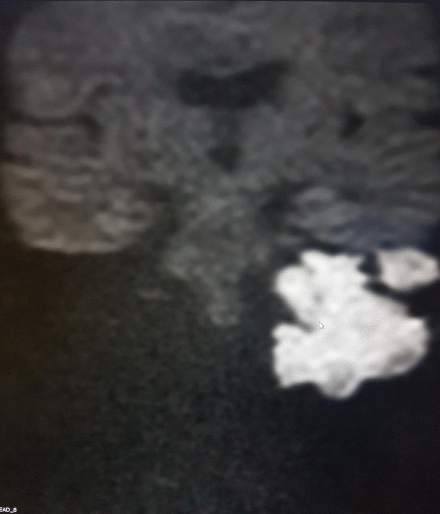 GiorgioConte86's tweet photo. @TheASNR @ASHNRSociety @DShatzkes @CMGlastonbury @callyrobs @PhilipRChapman1 @gmoonis @amyfjuliano @nakoontz @FeliceDArco @AtaSiddiqui4 @DrTaranath @WendeNGibbs @JudyGadde @Bert_DeFoer @GiorgioConte86 @LorenzoPinelli 
Never seen one so big...and you?😱 https://t.co/ds0g6CGTy7
