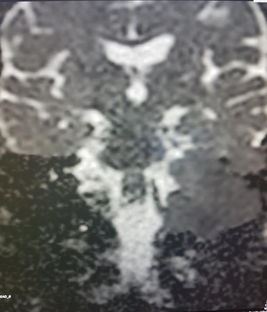 GiorgioConte86's tweet photo. @TheASNR @ASHNRSociety @DShatzkes @CMGlastonbury @callyrobs @PhilipRChapman1 @gmoonis @amyfjuliano @nakoontz @FeliceDArco @AtaSiddiqui4 @DrTaranath @WendeNGibbs @JudyGadde @Bert_DeFoer @GiorgioConte86 @LorenzoPinelli 
Never seen one so big...and you?😱 https://t.co/ds0g6CGTy7